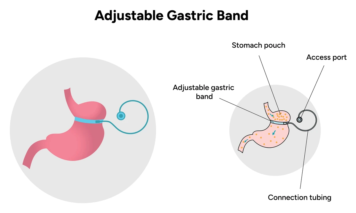Diagram of an adjustable gastric band