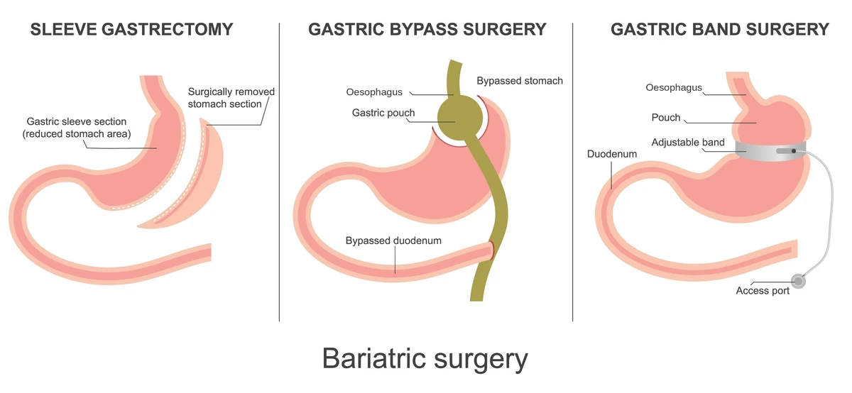 Diagram comparing sleeve gastrectomy, gastric bypass and gastric band
