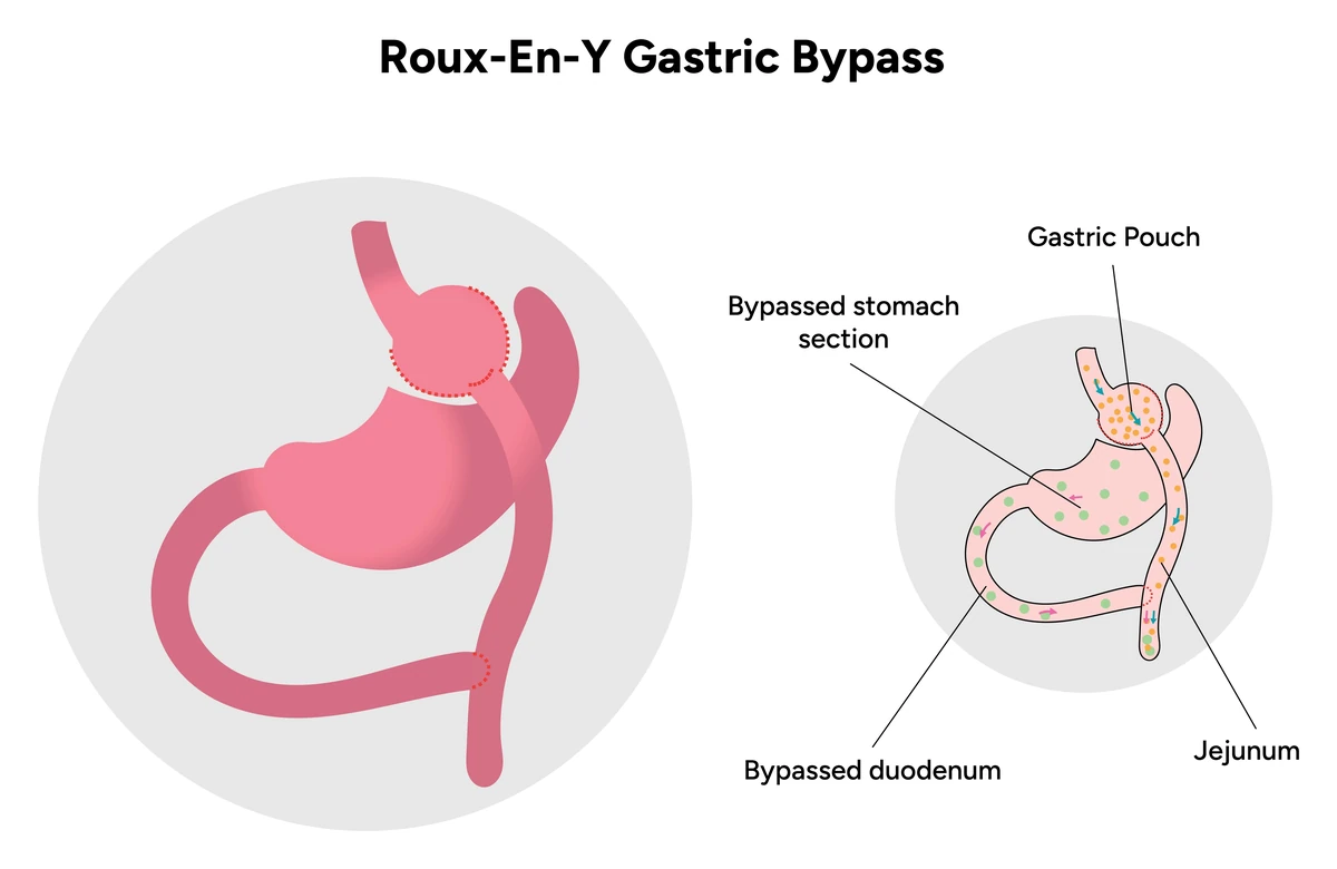 Diagram of a Roux-en-Y gastric bypass