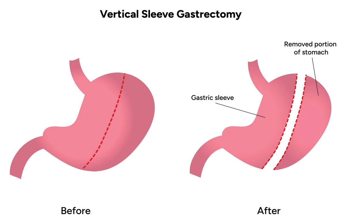 Diagram of the stomach before and after a sleeve gastrectomy